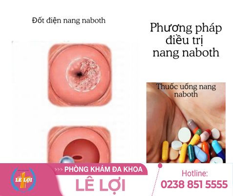 Điều trị nang naboth tử cung thế nào?