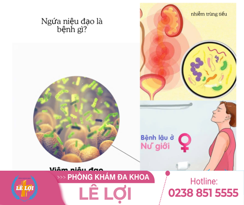 Ngứa Niệu Đạo Ở Nữ Giới Là Bệnh Gì? Nguyên Nhân Và Cách Chữa Trị