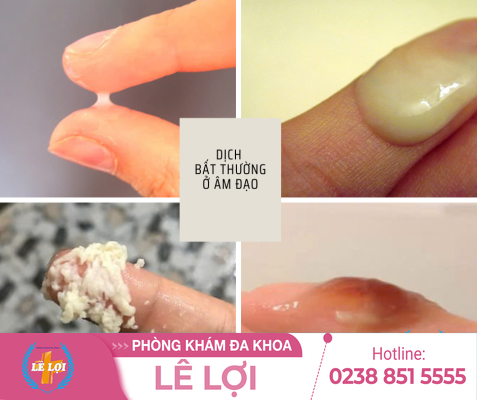 Âm đạo ra dịch bất thường là bệnh gì?