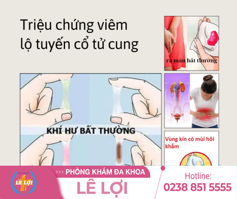 Triệu chứng lộ tuyến cổ tử cung