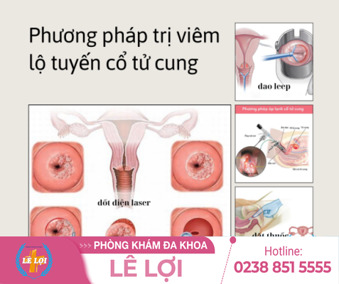 Chi phí đốt lộ tuyến cổ tử cung bao nhiêu tiền?