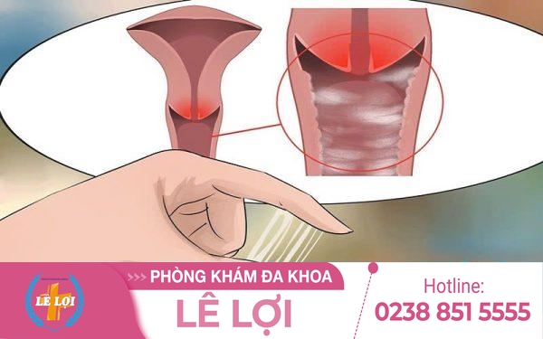 Nguyên nhân và cách khắc phục ra nhiều dịch âm đạo
