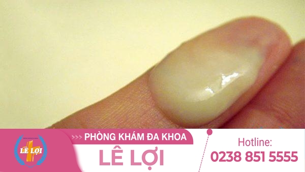 Khí hư màu vàng do đâu khắc phục thế nào?