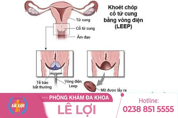 Cách điều trị polyp cổ tử cung