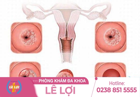 Đốt nang naboth tử cung quy trình và chi phí