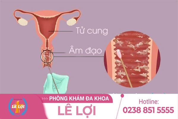 Dịch vón cục ở âm đạo là dấu hiệu bệnh gì?