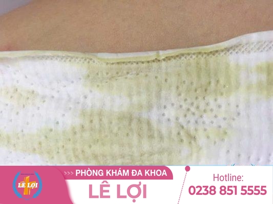Khí Hư Màu Xanh Là Biểu Hiện Của Bệnh Lý Gì?