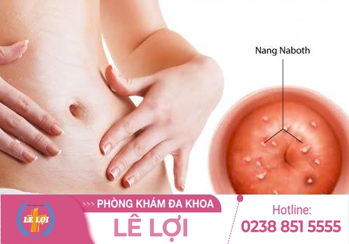 Đốt nang naboth cổ tử cung ở đâu hiệu quả an toàn?