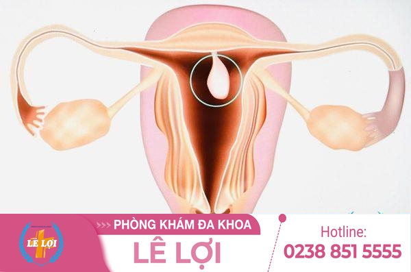 Nạo polyp tử cung là gì nguy hiểm không?