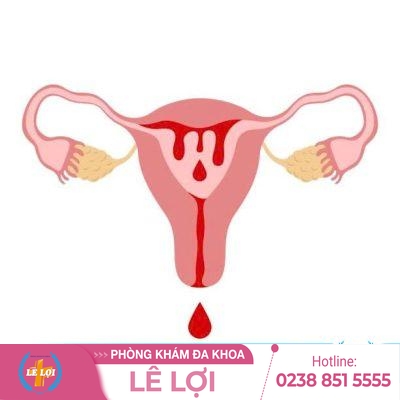 Ra Máu Ở Tử Cung Bất Thường Cẩn Thận Mắc Ung Thư Cổ Tử Cung