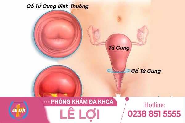 Điều Trị Viêm Tử Cung Ra Sao?