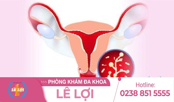 Viêm vùng chậu nguyên nhân dấu hiệu và cách chữa