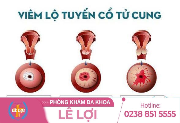 Cách chữa viêm lộ tuyến cổ tử cung hiệu quả