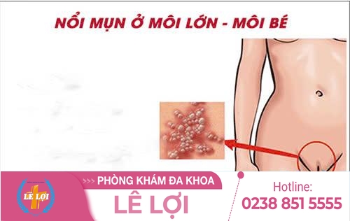 Nổi mụn môi lớn là bệnh gì?