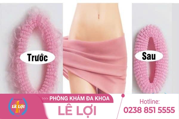 Giữ mãi nét xuân với phương pháp trẻ hóa âm đạo tiên tiến