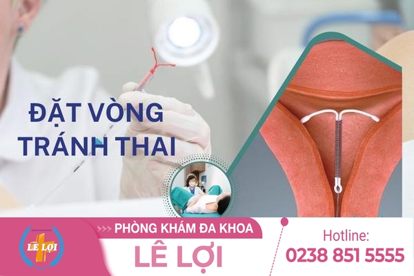 Chi phí đặt vòng tránh thai bao nhiêu tiền?