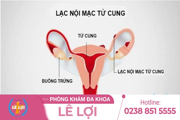 Triệu chứng lạc nội mạc tử cung và cách chữa trị