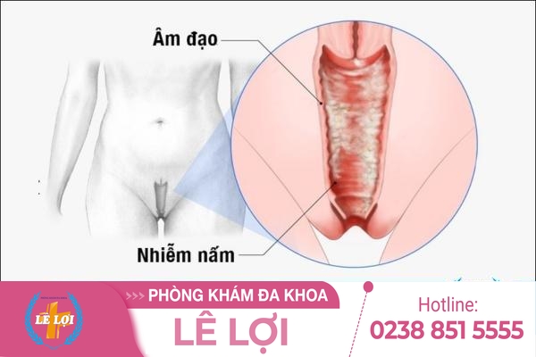 Thuốc điều trị nấm candida âm đạo hiệu quả
