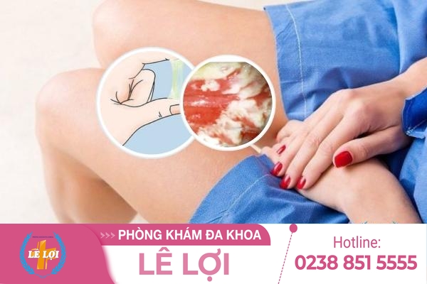 Dấu hiệu viêm âm đạo cấp và mãn tính