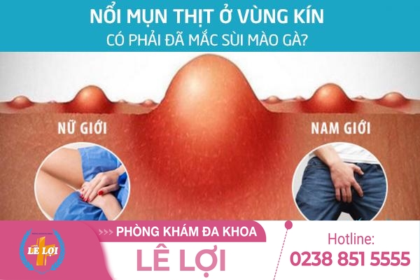 Nổi mụn thịt ở âm đạo là bị gì?