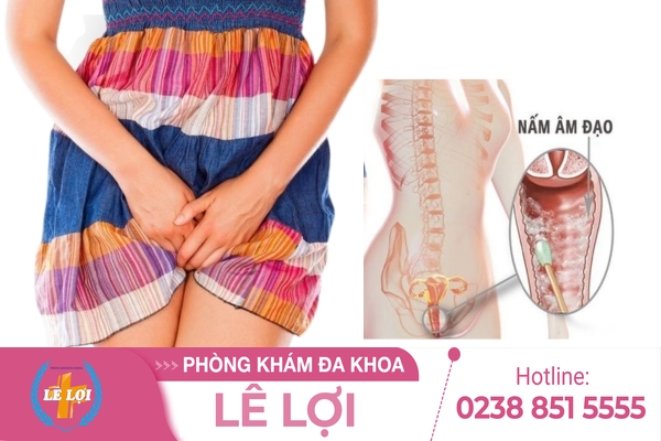 Nấm âm đạo và những thông tin cần biết