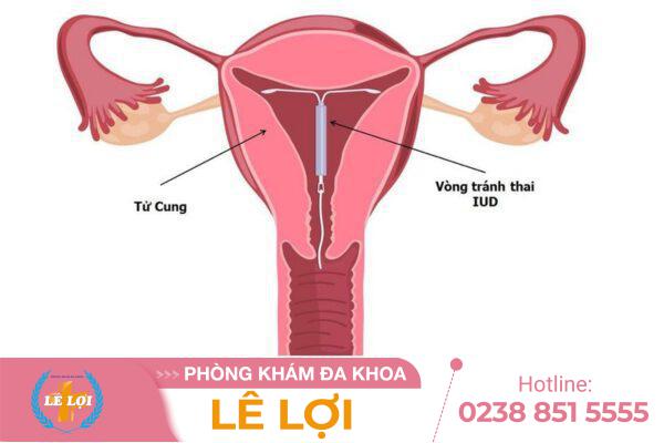 Tháo Vòng Tránh Thai  Không Đúng Cách – Nguy Cơ Viêm Nhiễm Và Biến Chứng Nguy Hiểm