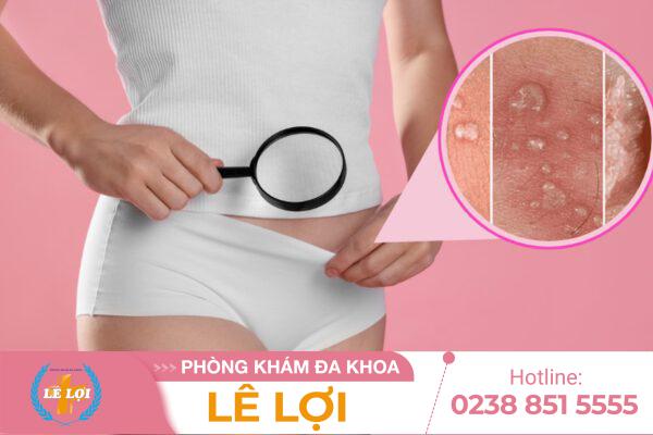 Bị nổi mụn ở âm đạo – nguyên nhân có thể khiến bạn bất ngờ!